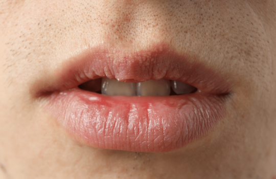 Nahaufnahme eines Mundes mit trockenen, rissigen Lippen und kurzem Bartwuchs