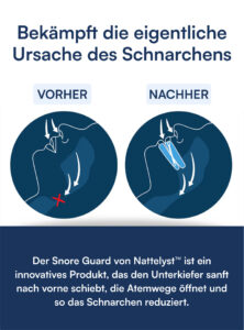 Schnarchschiene (Snore Guard)